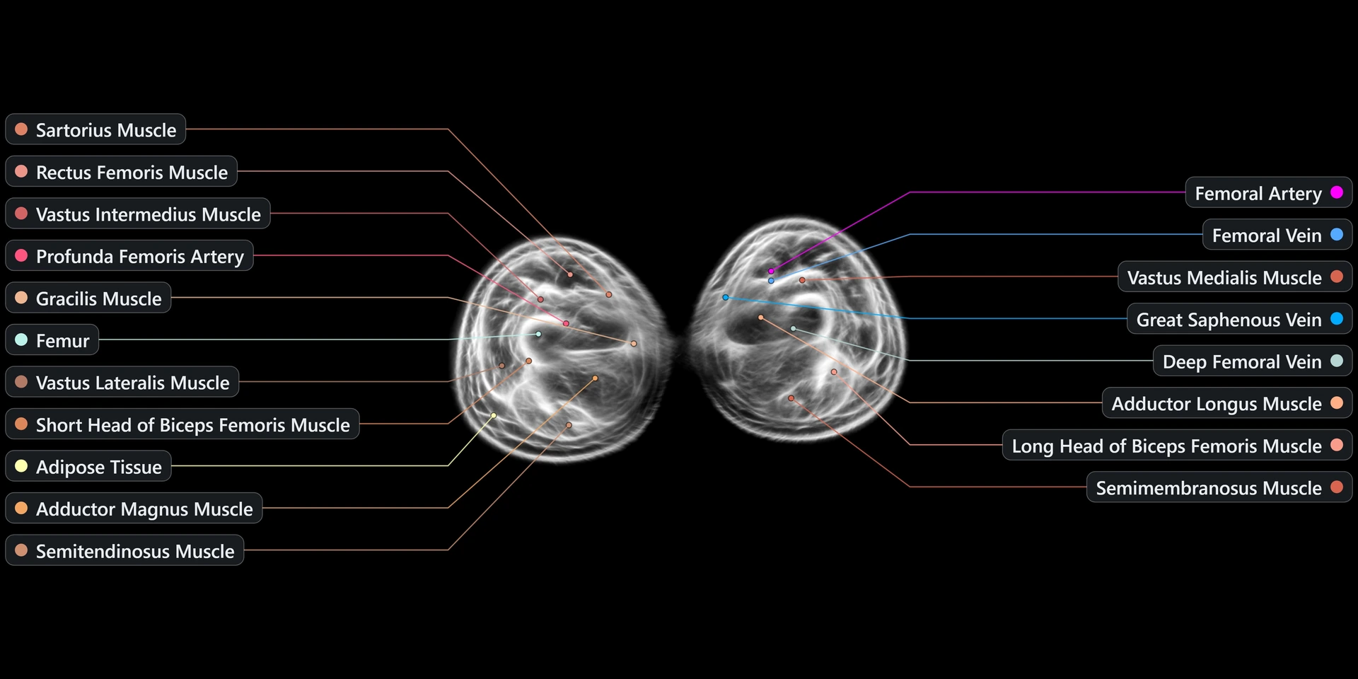 Reconstructed scan slice — female thigh
