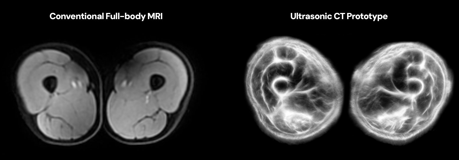 USCT reconstruction of the thighs compared with an MRI of the same region